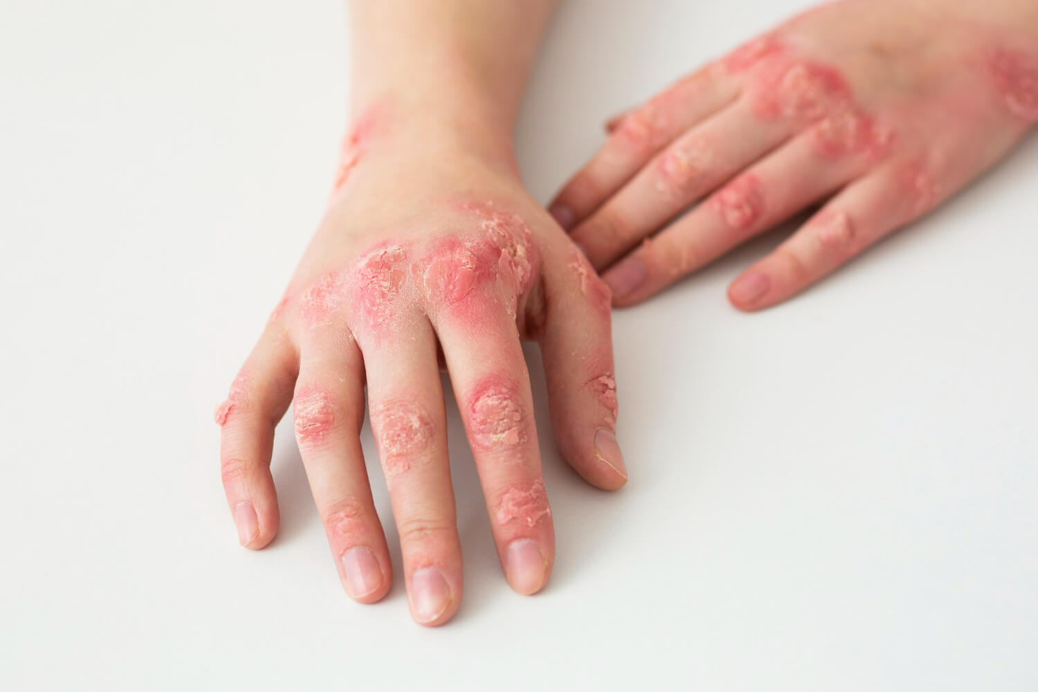 Cauze psoriasis Cauze psoriasis