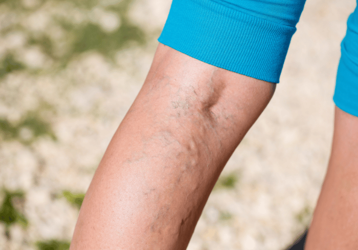 Varice sau vene varicoase