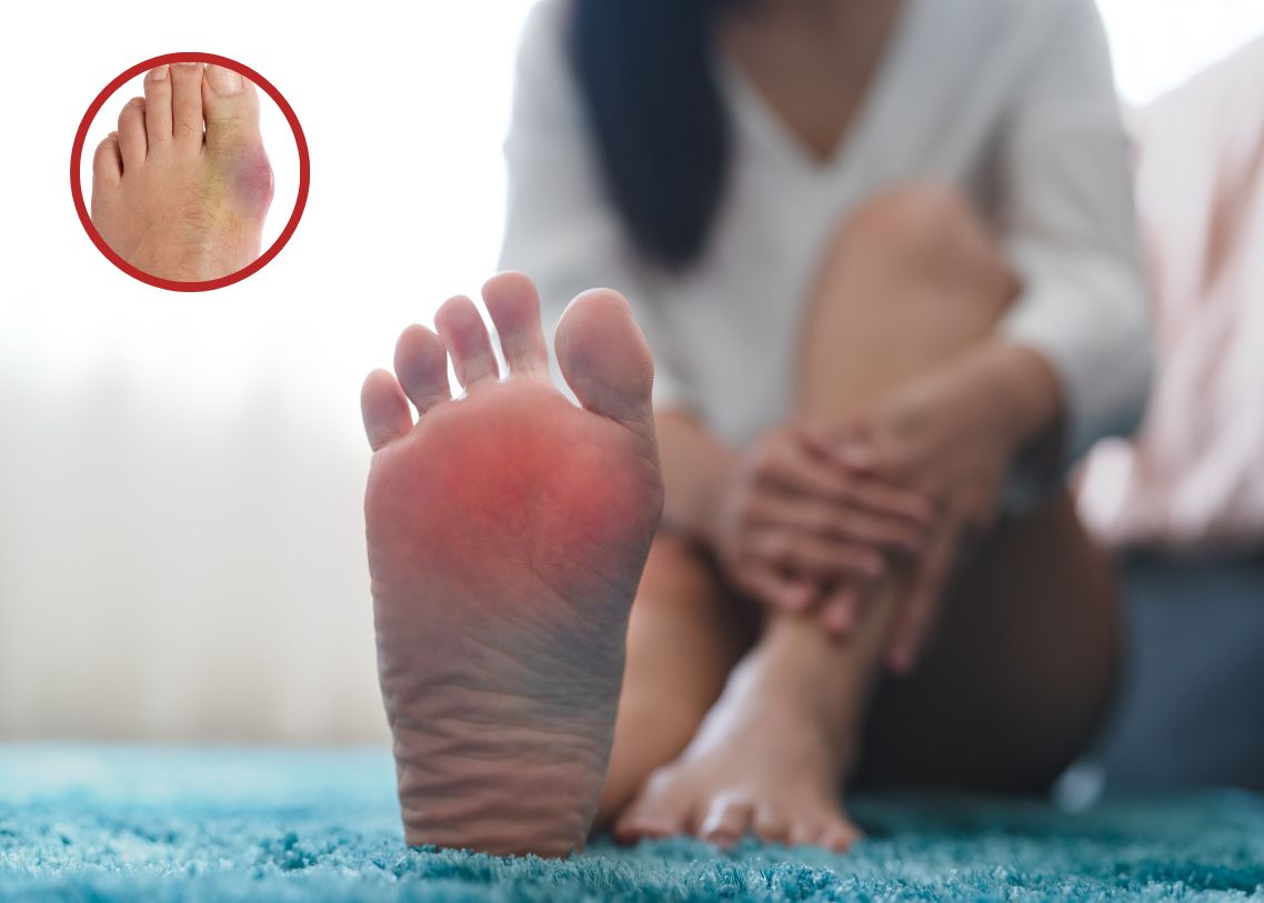 Guta cronica tofacee - noduli Guta cronica tofacee - noduli