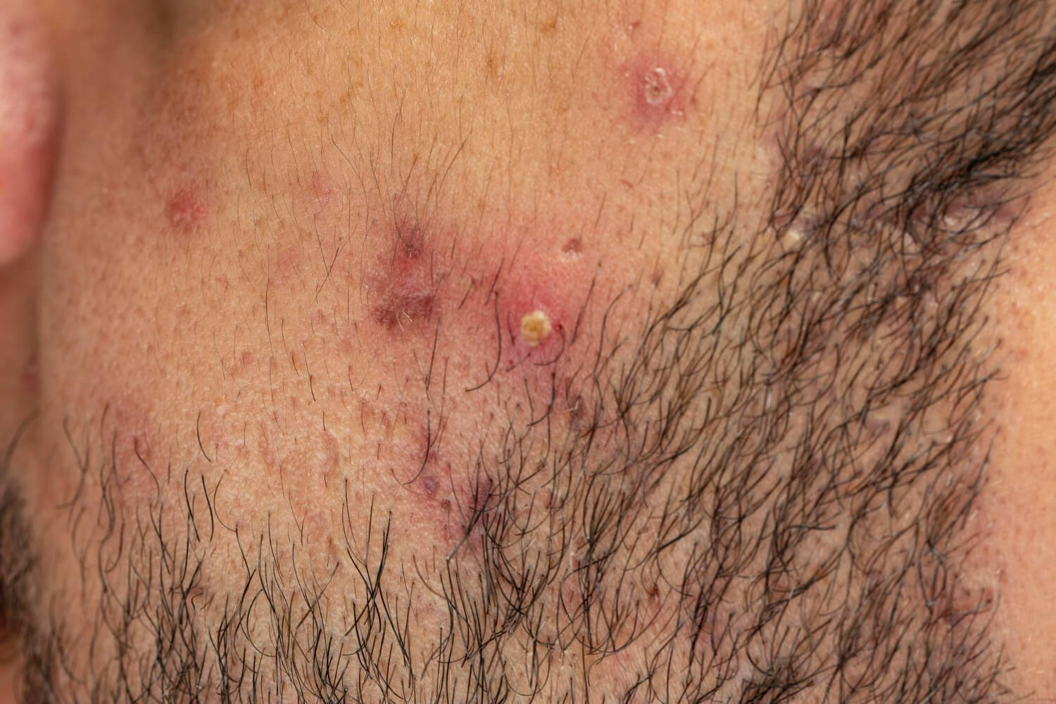 Foliculita Foliculita