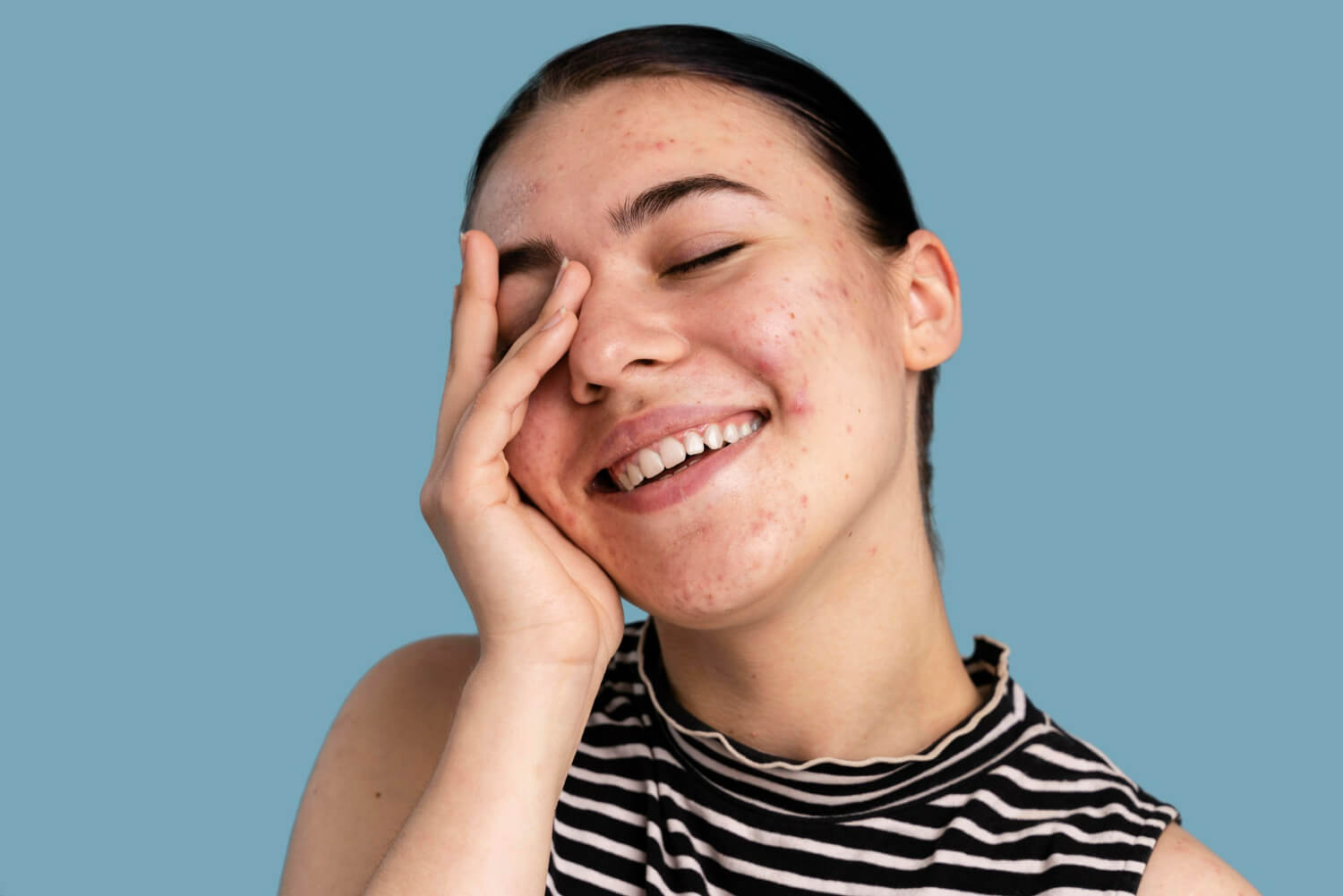 Remedii naturale acnee Remedii naturale acnee