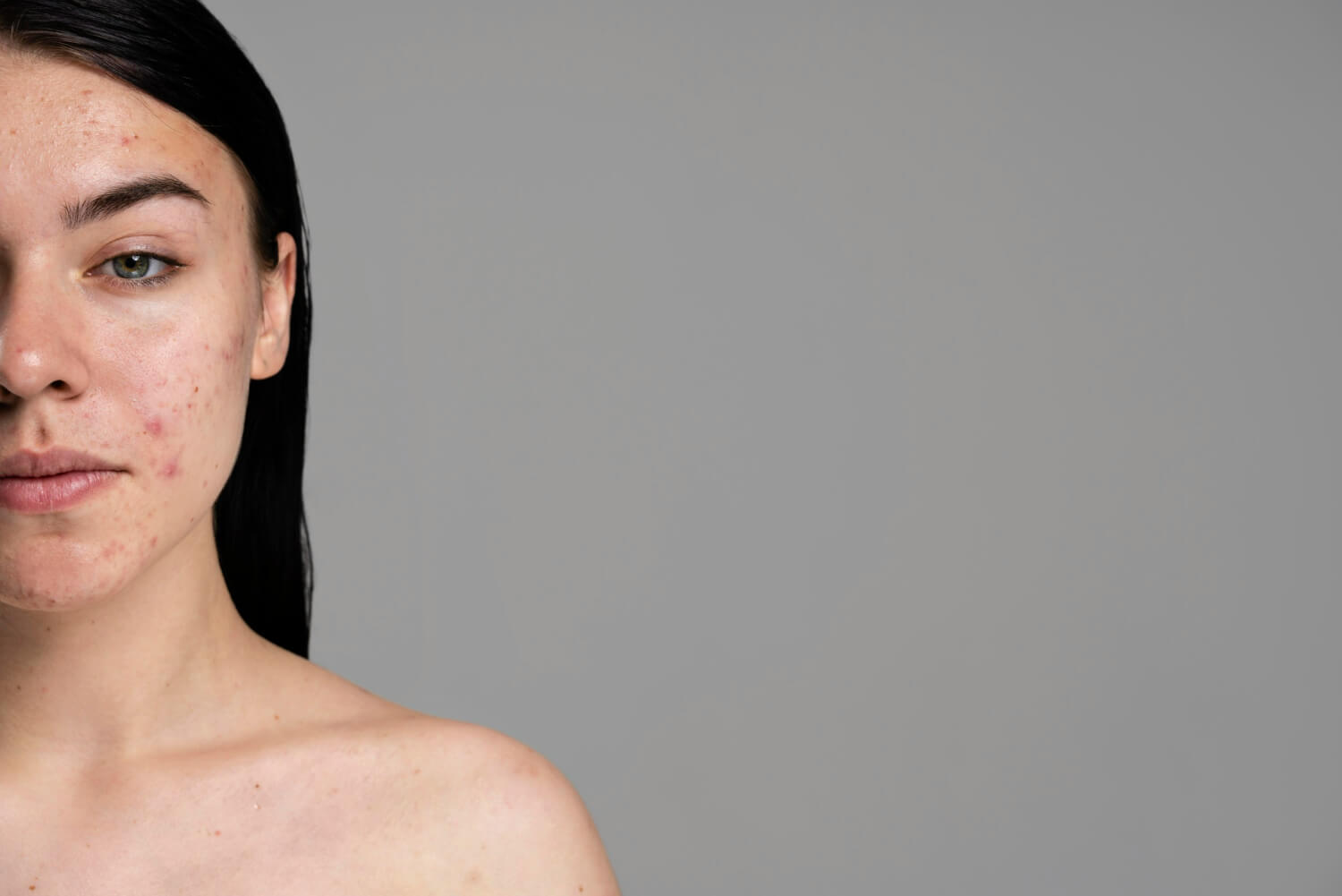 Cauze acnee Cauze acnee