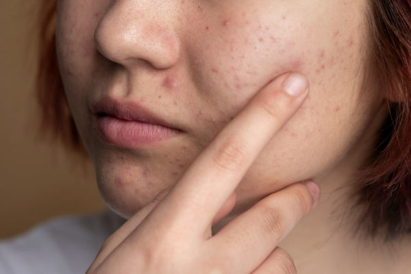 Acneea tardiva: cauze, semne si remedii naturale