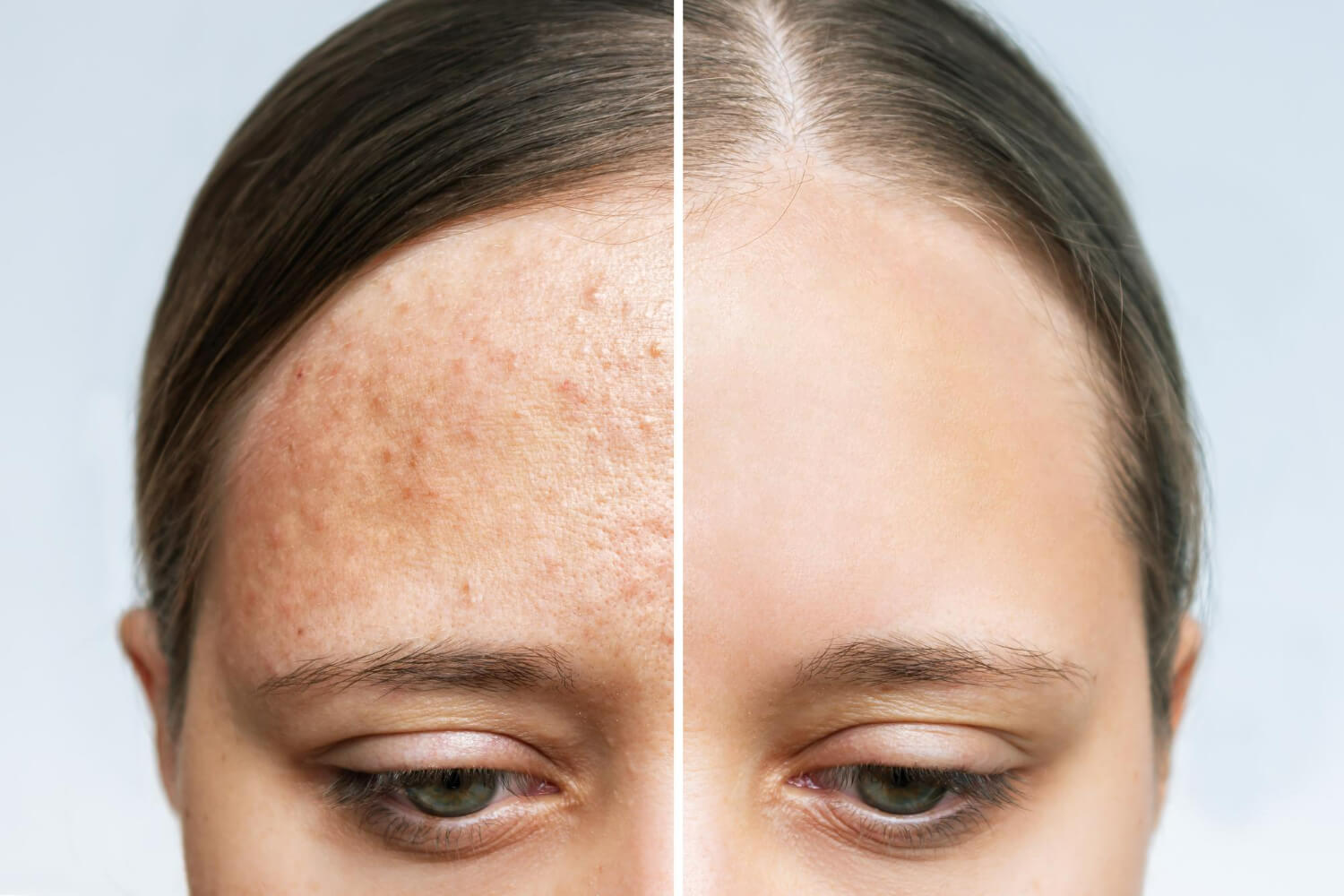 Ce este acneea in sarcina Ce este acneea in sarcina