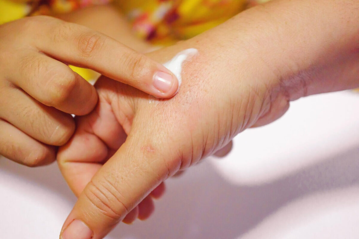 Ingrijrea pileii cu eczema