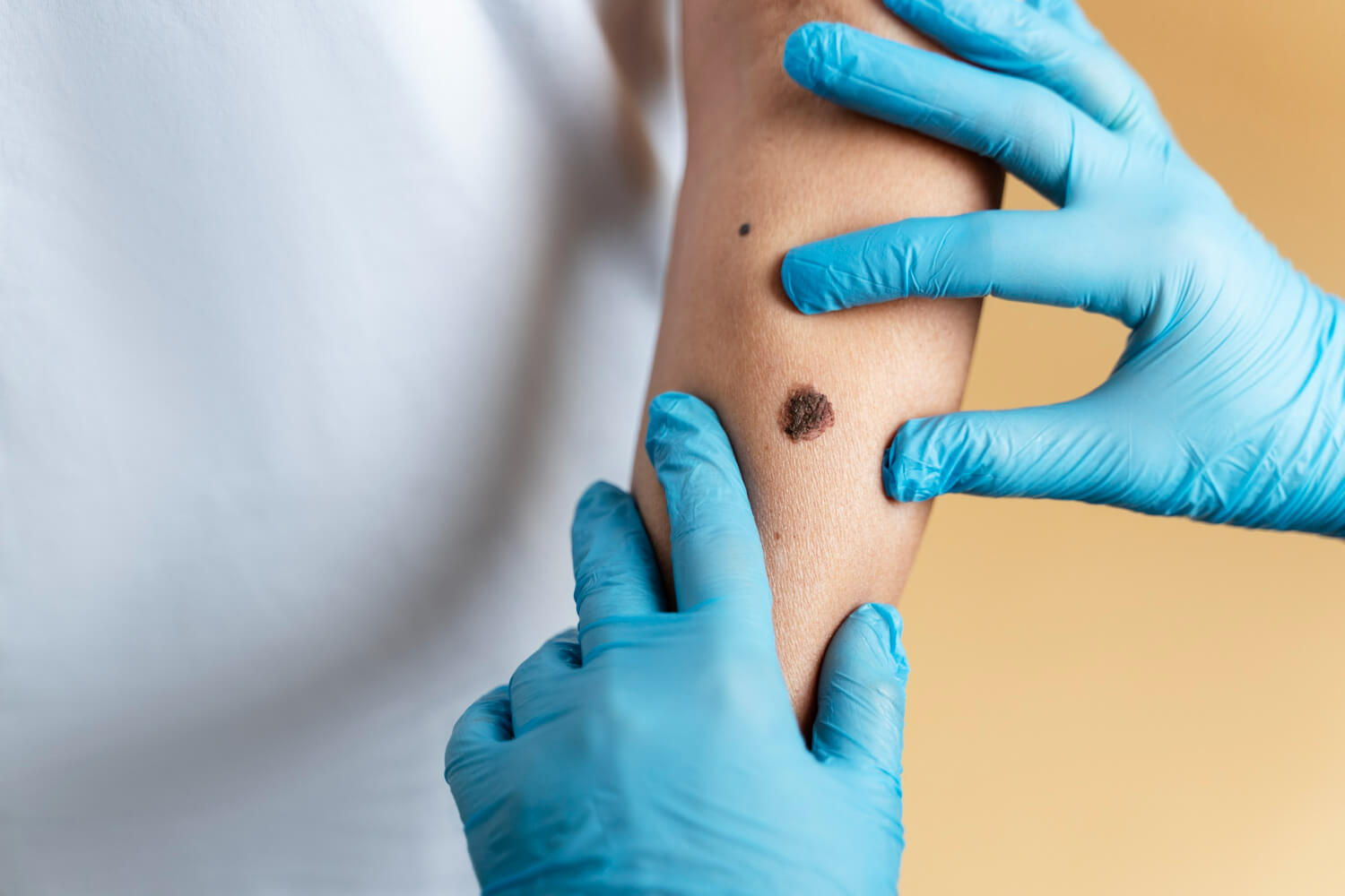 Screening cancer de piele Screening cancer de piele