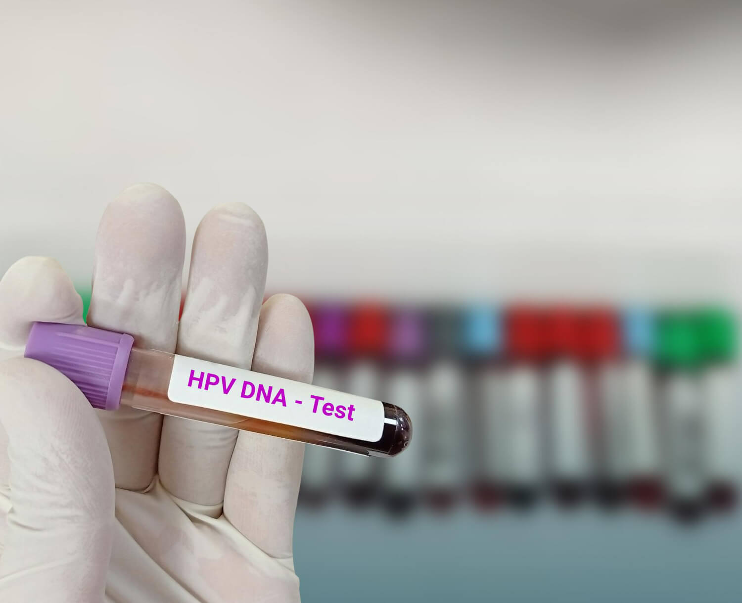 Depistarea infectiei cu hpv Depistarea infectiei cu hpv